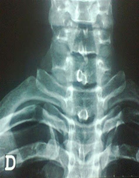 espina bifida radiografia